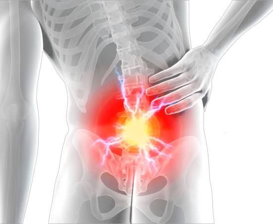 Радикулит / Защемление седалищного нерва / Ишиас. Лечение.