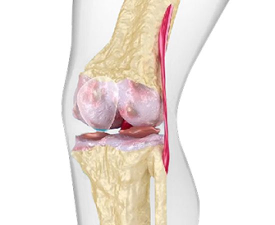Гонартроз. Лечение.