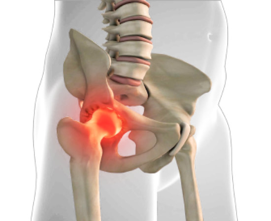 Коксартроз. Лечение.