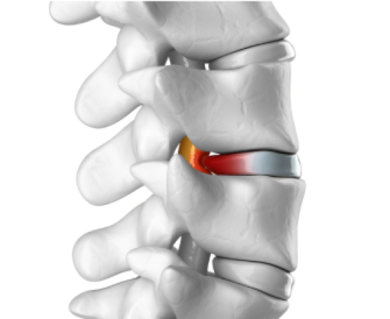 Лечение межпозвонковых грыж, протрузий межпозвонковых дисков, остеохондроза