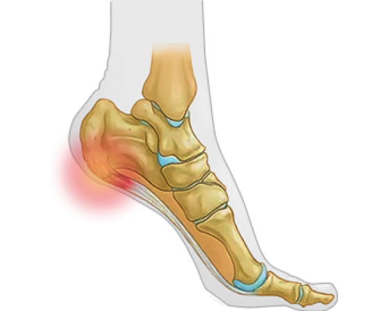 Лечение пяточной шпоры (плантарного фасциита)