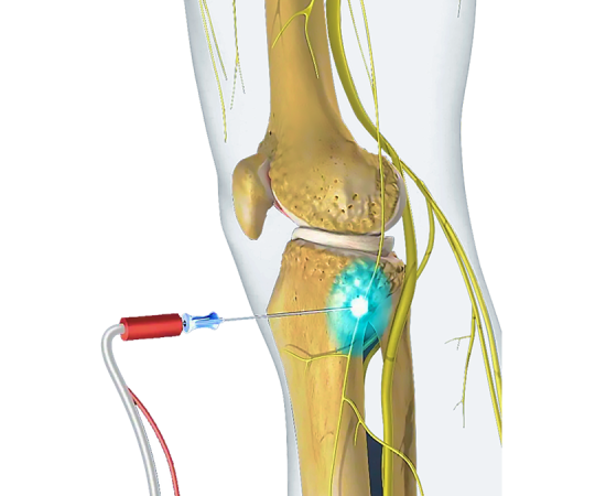 Криоденервация