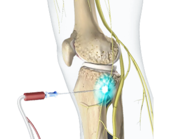 КРИОДЕНЕРВАЦИЯ (КРИОАБЛЯЦИЯ) СУСТАВОВ