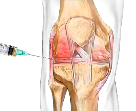 Плазмолифтинг  суставов
