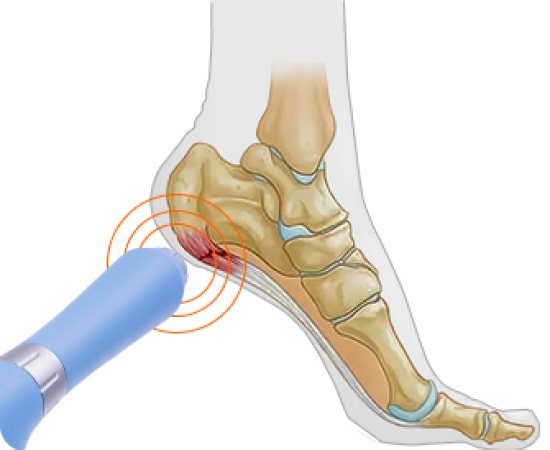 Ударно-Волновая терапия