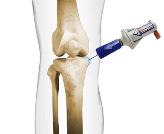 Внутрикостная терапия суставов