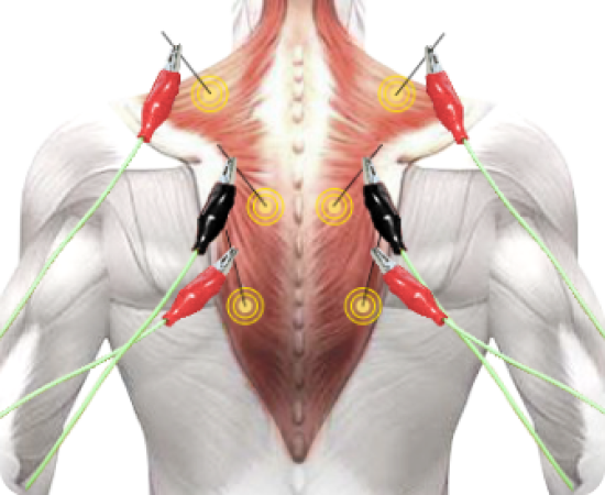 Внутритканевая <br/> электростимуляция (ВТЭС)