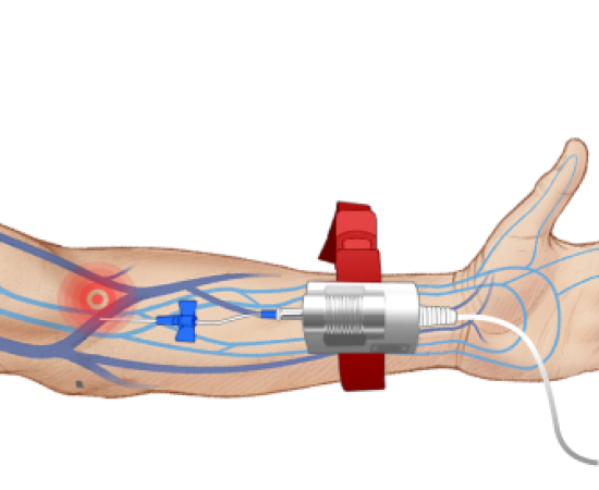 ВЛОК - внутривенное лазерное облучение крови