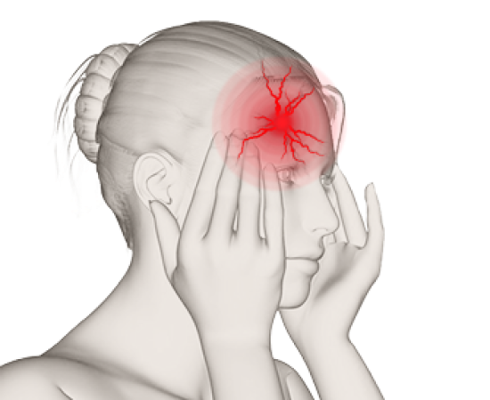 Лечение мигрени