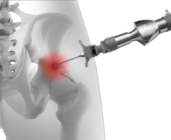 Внутрикостная терапия позвоночника
